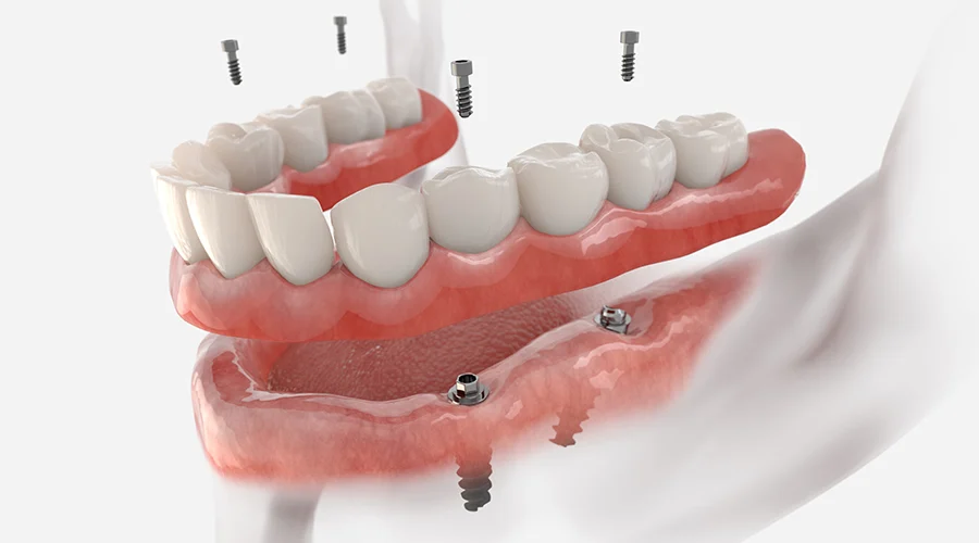 implant-supported dentures implant-supported dentures