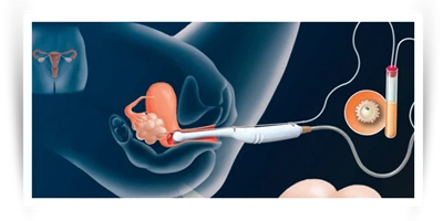 Trứng trứng trong IVF: Trứng được thu thập như thế nào?